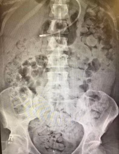 Ngực của Kelly Yeoman chứa đầy chất thải sau khi bác sĩ phẫu thuật làm hỏng ruột của cô. Ảnh: The Sun.