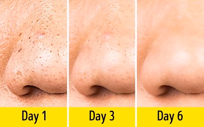 Đây là cách trị mụn hiệu quả: Trộn dầu thầu dầu với dầu hạt lanh (tỷ lệ 1: 3), thêm 2-3 giọt dầu cây chè và thoa lên da. Cách này giúp loại bỏ các vết dầu và vết đen trên khuôn mặt bạn. Ảnh: Depositphotos.