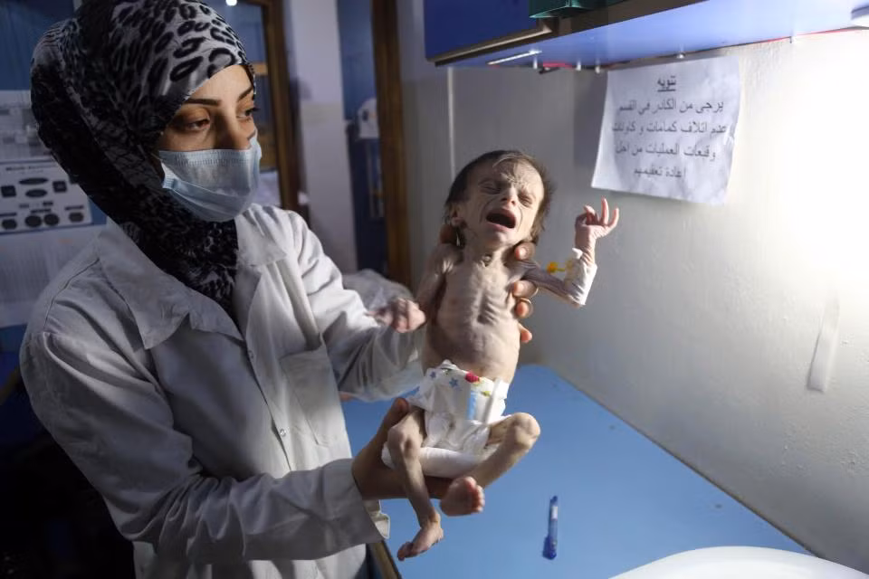 Xot xa be trai suy dinh duong chi nang 1,8kg