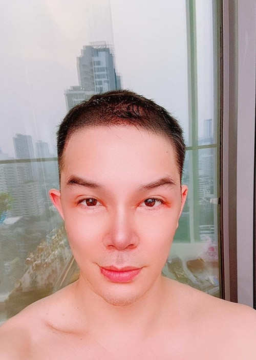 Nathan Lee trải qua ca phẫu thuật thu gọn vùng đầu trong tháng 3. Ảnh: FBNV.