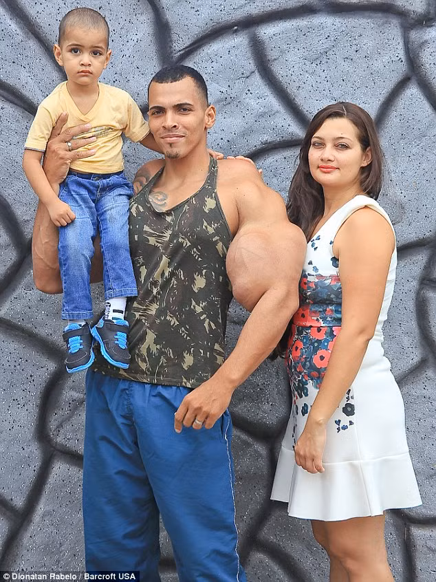 Bắp tay khủng của Romario Dos Santos Alves sau tiêm hợp chất giữa dầu và rượu.