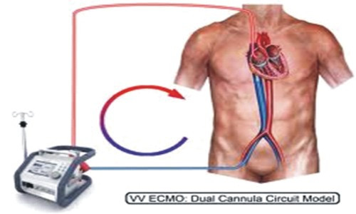 ...và ECMO tĩnh mạch – tĩnh mạch (Venovenous – VV ECMO).