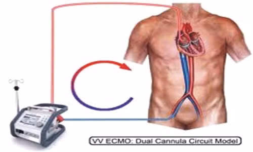 ...và ECMO tĩnh mạch – tĩnh mạch (Venovenous – VV ECMO).
