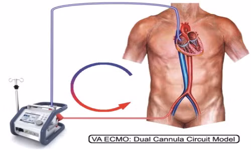 ECMO có 2 mode cơ bản là ECMO tĩnh mạch – động mạch (Venoarterial – VA ECMO