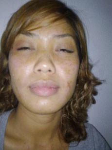 Hồi năm 2012, Chị Chu Thị Lan, SN 1982, trú tại thành phố Vĩnh Yên, tỉnh Vĩnh Phúc bỗng dưng bị bỏng rát toàn thân, mặt mày tím tái, khó thở … phải vào viện cấp cứu.