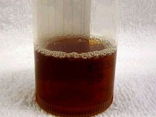 Nước tiểu màu vàng đậm. Nguyên nhân xảy ra hiện tượng này là do nước tiểu chứa nhiều chất độc. Khi cơ thể có đủ nước, chất độc dễ dàng được thải ra ngoài, nhưng cơ thể khi bị mất nước, chất độc khó bị đào thải và tích tụ lại. Lượng nước tiểu ít đi và bị cô đặc lại chuyển thành màu vàng đậm.