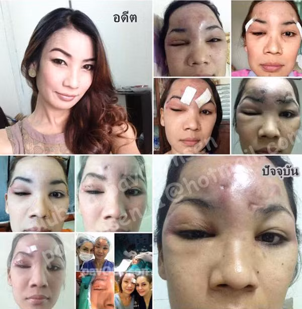 Gai tre mu mat do tiem silicon long don tran