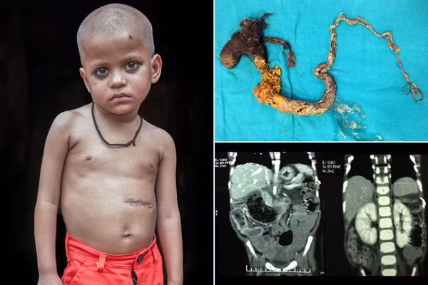 Thực tế, y văn đã ghi nhận nhiều trường hợp mắc phải hội chứng này, đặc biệt là các bệnh nhân nhỏ tuổi. Gần đây nhất là trường hợp cậu bé Ấn Độ Sivam Kumar, 4 tuổi đã có thói quen ăn tóc suốt 9 tháng, dẫn đến thường xuyên bị nôn, không thể ăn uống bình thường đồng thời bị suy dinh dưỡng và mất nước. Các bác sĩ phát hiện một búi tóc dài tới 1,22 mét trong dạ dày Sivam sau khi chụp X-quang.