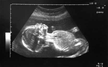 Chào đời sau khi mẹ chết lâm sàng 3 tháng. Một em bé Hungary chào đời khỏe mạnh bằng phương pháp mổ đẻ dù người mẹ đã chết lâm sàng 3 tháng trước đó. Các bác sĩ ở bệnh viện của trường Đại học Debrecen, miền đông Hungary, cho biết người mẹ đã bị chảy máu não và chết lâm sàng khi mang thai ở tuần thứ 15 hồi tháng 4/2013. Tuy nhiên, các bác sĩ đã duy trì sự sống cho cô và đứa bé chào đời bằng phương pháp mổ đẻ ở tuần thứ 27 hồi tháng 7. Khi đó, bé nặng 1,4 kg.