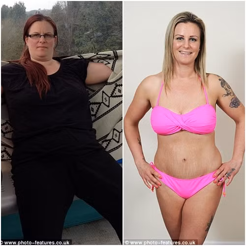 Cô Natalie Davis, 35 tuổi, sống tại Manchester (Anh) đã giảm được 44kg sau 7 tháng ăn kiêng. Tuy nhiên, hậu quả đi kèm khiến bụng cô lùng nhùng da thừa xấu xí.