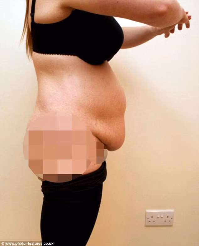 Chính vì vậy cô này quyết định chi số tiền lớn đi cắt da thừa ở bụng.