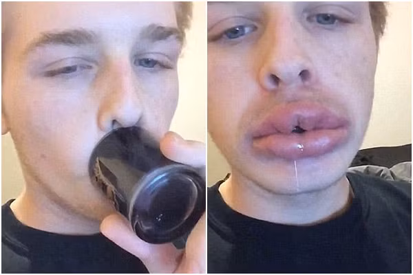 Dụng cụ để “bơm môi” theo trào lưu quái đản này rất phong phú. Có teen dùng cốc, chén, chai, hay bất kỳ món đồ có miệng tròn và đáy kín.