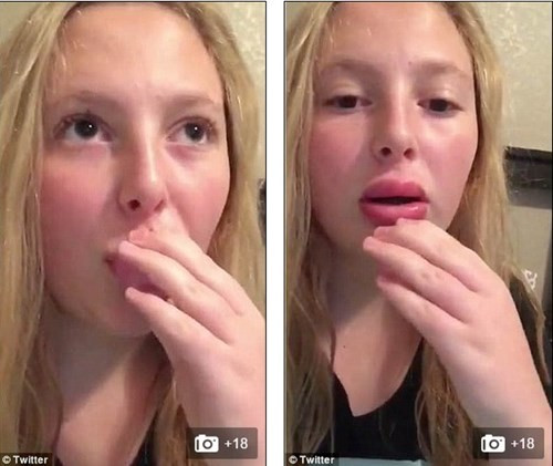 Nhiều người hối hận và cho rằng việc bơm môi bằng cốc, chai là ngu ngốc.