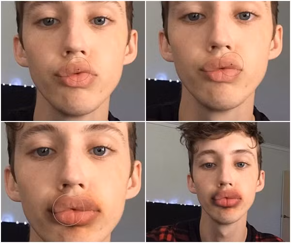 Trào lưu bơm môi bằng cách hít nắp chai kì dị bắt nguồn từ tài khoản instargram #KylieJennerChallenge hoạt động bằng cách kéo căng môi làm tăng lưu lương máu. Khi đó các mạch máu được mở rộng, gây ra giãn mạch máu, lưu lượng máu dồn lên sẽ gây sưng tấy, khiến bạn trở thành thảm họa bơm môi trước mặt người khác.