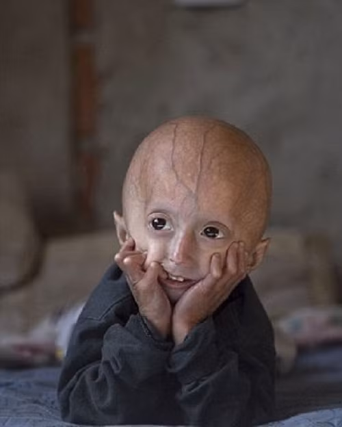 Franco Villavicencio, em bé 4 tuổi sống tại Moreno, Argentina bị mắc chứng bệnh lão hóa sớm progeria, khiến cơ thể lão hóa nhanh gấp 8 lần bình thường và không thể sống sót quá 13 tuổi.