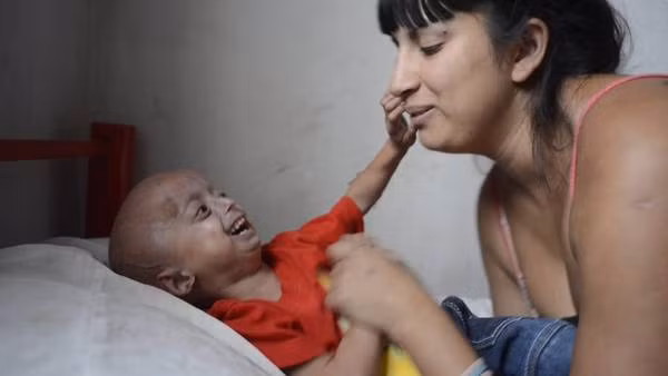 Hiện có khoảng 74 trường hợp mắc bệnh này trên thế giới được y văn xác nhận, trong đó có 4 trường hợp ở Anh.