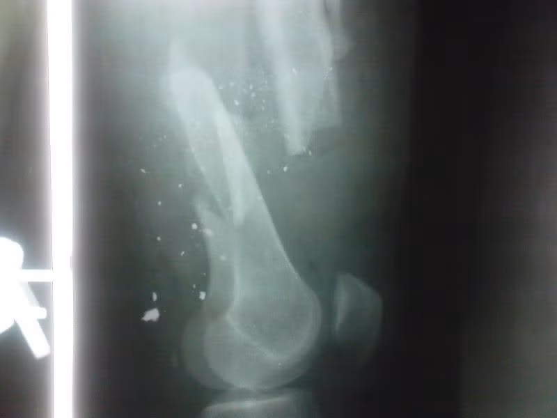 Nếu không gắp hết những mảnh đạn vỡ bằng kim loại bên trong cơ thể ra, nạn nhân sẽ vẫn có nguy cơ tử vong do những mảnh đạn này bị rỉ sét bên trong cơ thể, gây ra nhiễm trùng máu nặng. Ảnh: Một nạn nhân dính đạn 5,56x45mm làm vỡ xương đùi , văng ra rất nhiều mảnh xương và mảnh đạn bên trong đùi. Nguồn ảnh: Wiki.