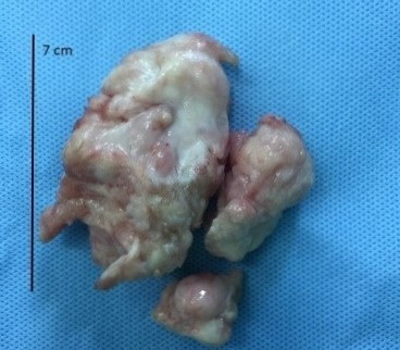 Boc tach thanh cong khoi u hiem gap bop nghet trai tim be 4 thang tuoi-Hinh-2