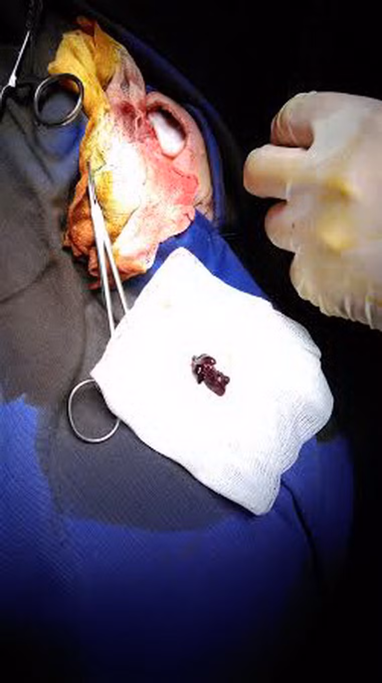 Khối máu tụ và não dập