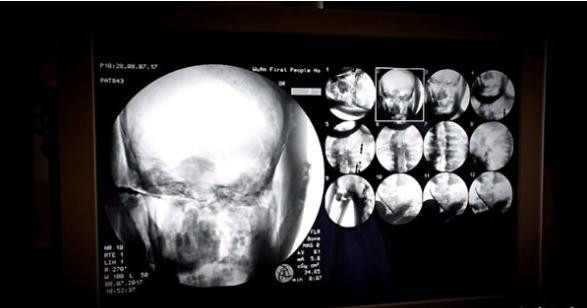 Cụ thể, các chuyên gia tiến hành chụp X-quang xác ướp nhà sư Từ Hiền. Nhờ vậy, họ phát hiện thi hài nhà sư Từ Hiền vẫn còn đầy đủ xương cũng như sọ não.