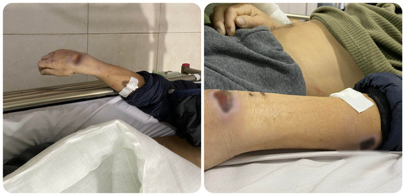 Goc nhin phap ly vu 2 cuu cong an Vu Thu dung nhuc hinh chet nguoi