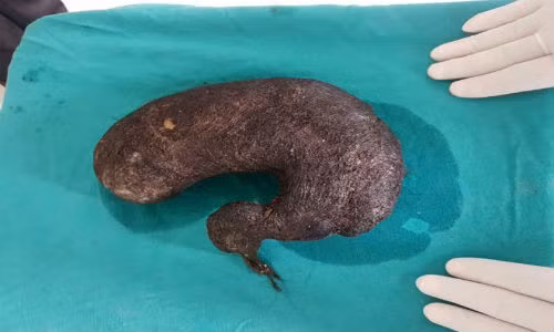 Phau thuat loai bo bui toc trong da day thieu nu 16 tuoi