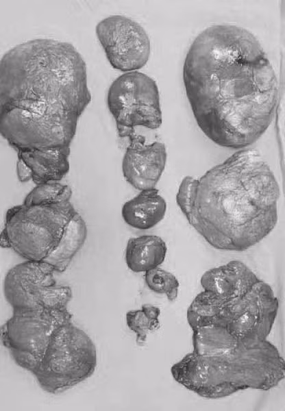 Tuong beo bung, hoa ra dang mang 20 u mo-Hinh-2