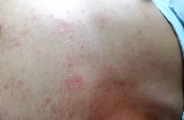 Ha Noi: Qua tai benh nhan sot xuat huyet, bac si 'cang minh' chong dich-Hinh-2