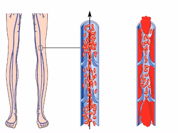 Tăng nguy cơ mắc bệnh tĩnh mạch. Các chuyên gia khuyến cáo việc uống thuốc này làm tăng nguy cơ huyết khối tĩnh mạch sâu gấp 3 lần. Trong một số nghiên cứu, các nhà khoa học làm giảm hàm lượng estrogen trong viên thuốc ngừa thai thì nhận thấy tần suất mắc bệnh huyết khối tĩnh mạch ở người dùng cũng giảm theo. Các nghiên cứu cũng ghi nhận những loại thuốc ngừa thai đường uống thế hệ mới có chứa các progesterol mới cũng làm tăng nguy cơ huyết khối tĩnh mạch sâu.