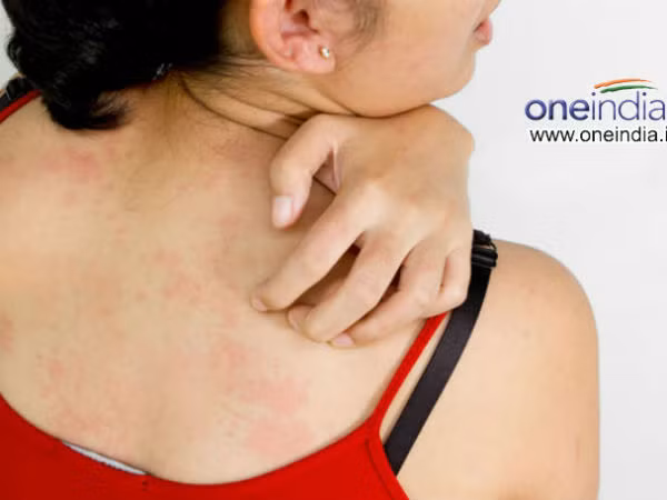 Dị ứng da. Dị ứng da là một trong những tác dụng phụ sau khi uống thuốc tránh thai. Tuy nhiên, uống quá liều có thể gây sưng, phát ban, ngứa liên tục trên da.