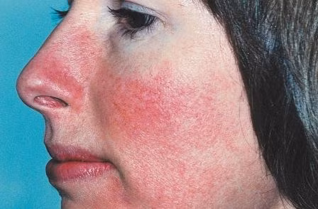 Chứng đỏ mặt. Nếu da xung quanh mũi, cằm, má, trán và mắt trở nên đỏ và bỏng, đó là bệnh Rosacea (chứng đỏ mặt). Những vệt này đỏ hoài không hết và các mạch máu bắt đầu xuất hiện dưới da. Những vết bị đau hay mụn nhọt đầy mủ cũng là dấu hiệu sớm của ung thư da.