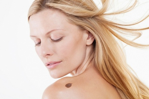 Xuất hiện các vết chàm do vùng da sần lên. Khi quan sát các vùng da tại đầu gối, khuỷu tay, mu bàn tay… nếu bạn phát hiện thấy da sần lên bất thường thì cần đến ngay bác sĩ chuyên khoa để được khám và chẩn đoán bệnh chính xác. Thông thường, các vết chàm này là những vết chàm bội nhiễm trên da và cũng là dấu hiệu của ung thư da giai đoạn đầu.