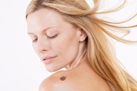 Xuất hiện các vết chàm do vùng da sần lên. Khi quan sát các vùng da tại đầu gối, khuỷu tay, mu bàn tay… nếu bạn phát hiện thấy da sần lên bất thường thì cần đến ngay bác sĩ chuyên khoa để được khám và chẩn đoán bệnh chính xác. Thông thường, các vết chàm này là những vết chàm bội nhiễm trên da và cũng là dấu hiệu của ung thư da giai đoạn đầu.