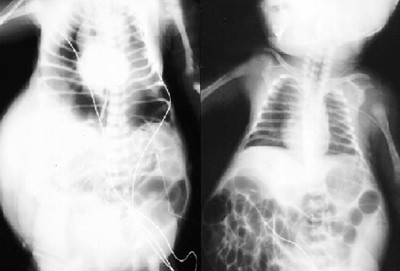 Sau khi sinh, siêu âm và chụp Xquang có thể xác định được các tổn thương bất thường về đường tiết niệu. Ảnh: Tổn thương mất cơ bụng trên phim Xquang.