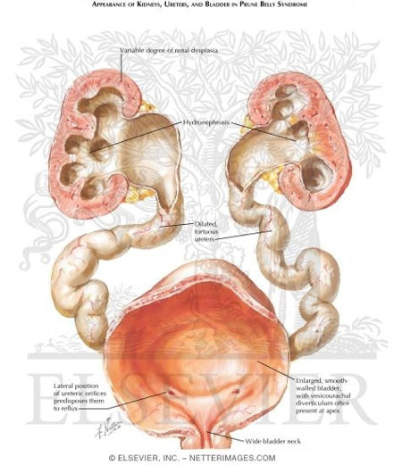 Biến chứng suy thận sẽ đòi hỏi bệnh nhi phải chạy thận nhân tạo hoặc ghép thận. Tuy nhiên, nếu được điều trị thích hợp, bệnh nhi mắc hội chứng này vẫn có cuộc sống khỏe mạnh và thọ như người bình thường. Cho đến nay, vẫn chưa có phương pháp nội khoa để điều trị hội chứng này mà chủ yếu là phải phẫu thuật để điều trị. Giống như hầu hết các rối loạn, việc điều trị phụ thuộc vào mức độ nghiêm trọng của các triệu chứng.