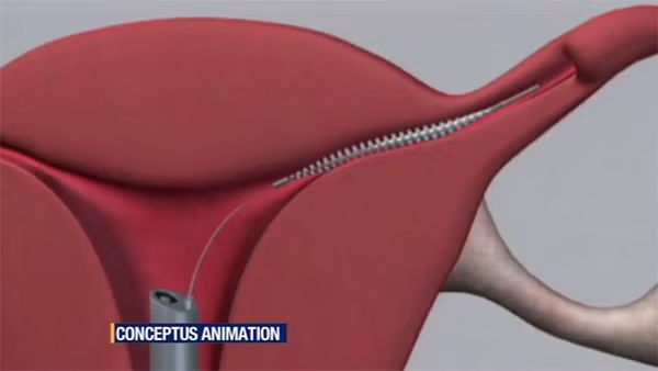  Lò xo tránh thai Essure được xem là phương pháp triệt sản mà không cần phẫu thuật có thể gây ra những mối nguy hại đến sức khỏe phụ nữ. 