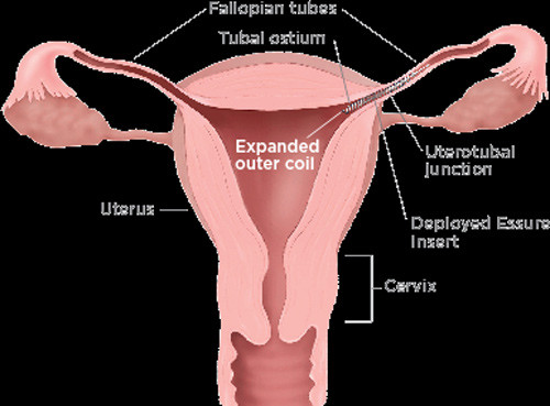 Đây là biện pháp tránh thai được FDA phê duyệt và áp dụng từ năm 2002. 