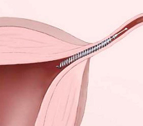 Lo ngại về biện pháp tránh thai Essure này lại một lần nữa dấy lên lo ngại khi kết quả nghiên cứu gần đây phát hiện thiết bị này có thể tăng nguy cơ nhiễm trùng và nhiều vấn đề sức khỏe đáng lo ngại khác. 