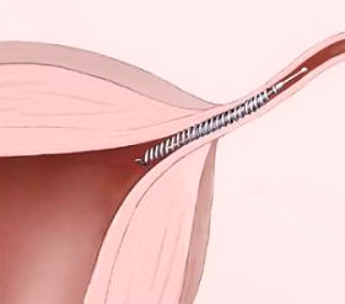 Lo ngại về biện pháp tránh thai Essure này lại một lần nữa dấy lên lo ngại khi kết quả nghiên cứu gần đây phát hiện thiết bị này có thể tăng nguy cơ nhiễm trùng và nhiều vấn đề sức khỏe đáng lo ngại khác. 