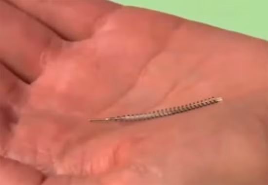 Essure là thiết bị nhỏ hình lò xo được cấy vào vòi trứng qua đường âm đạo. Sau 3 tháng, mô sẹo mới hình thành bít kín ống, ngăn không cho trứng đi xuống tử cung.