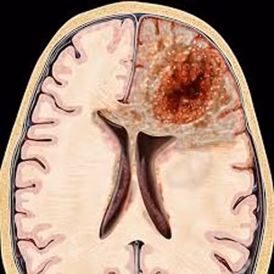 Glioblastoma tấn công vào bộ não vốn đang khỏe mạnh của con người và tạo ra các khối u không thể cắt bỏ khiến cho bệnh nhân có thể tử vong trong vòng 2 năm kể từ khi mắc bệnh.