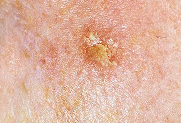 Trong khi hầu hết người Việt không hề che đậy hay dùng kem chống nắng khi ra ngoài, tia cực tím sẽ tác động đến tế bào da, gây khối u ung thư hắc tố chết người.