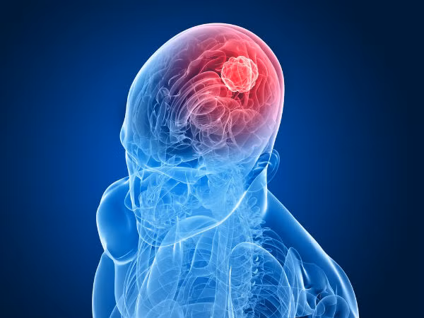 Ung thư não thứ cấp. Đây là dạng phổ biến nhất của ung thư não. Trong ung thư não thứ cấp, tế bào ung thư lây lan từ bất kỳ phần nào của cơ thể lên não.