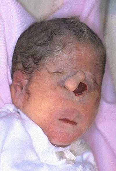 Cũng có ý kiến cho rằng, nguyên nhân sâu xa của trường hợp này là do sự tác động của một số loại chất độc và hóa trị liều cao.