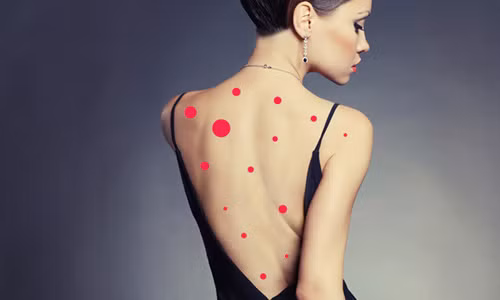 Thoát khỏi nguy cơ nổi mụn ở ngực và lưng. Áo ngực cũng có thể gây kích ứng da và gây ra các vấn đề về da như nổi cục và mẩn đỏ. Nguyên nhân là bởi chất vải làm áo ngực có thể tiếp xúc với phần da dễ bị dị ứng này, nhẹ thì gây mụn trứng cá, nặng thì có thể gây ung thư vú.