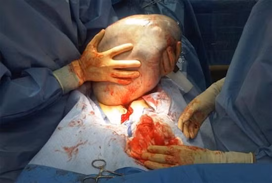 U nang buồng trứng có thể phát triển từ các mô của buồng trứng hay từ mô của các cơ quan khác trong cơ thể.