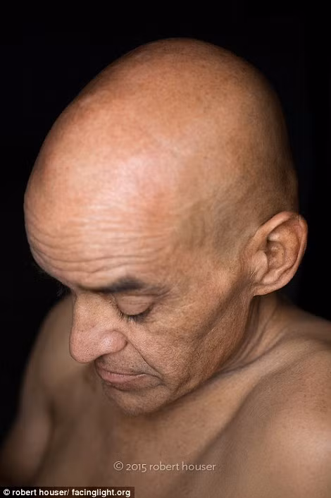 Nét trầm tư trên khuôn mặt một bệnh nhân ung thư.