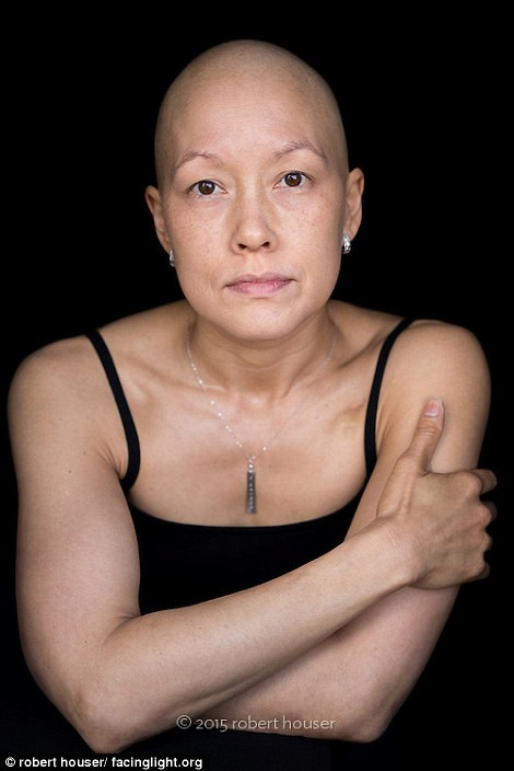 Những bệnh nhân rụng tóc do hóa trị ung thư không hề mất đi nét đẹp