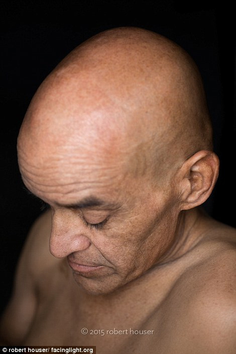 Nét trầm tư trên khuôn mặt một bệnh nhân ung thư.