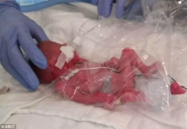 Sóc lạ: Mẹ mang thai doi bong sinh non mot be-Hinh-2